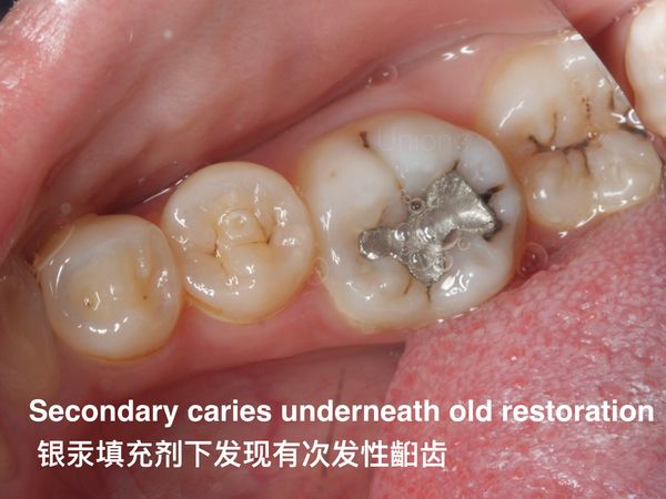 Molar Class 1 Composite – Union Dental