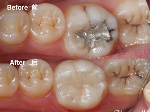 Molar Class 1 Composite – Union Dental