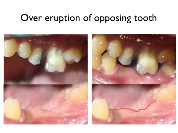 impact-of-tooth-extraction-union-dental